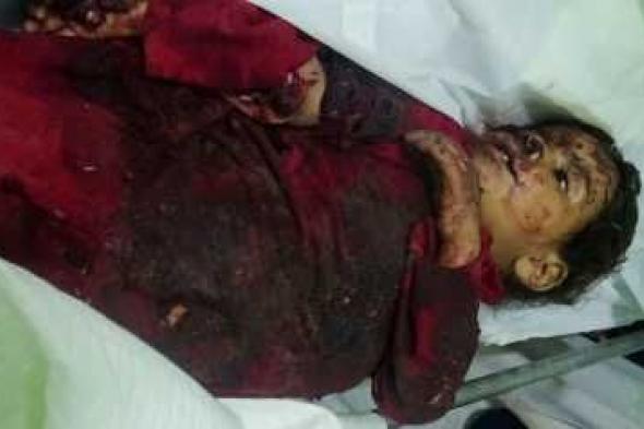 أخبار اليمن : 46 شهيداً وجريحاً جراء الألغام والقنابل العنقودية