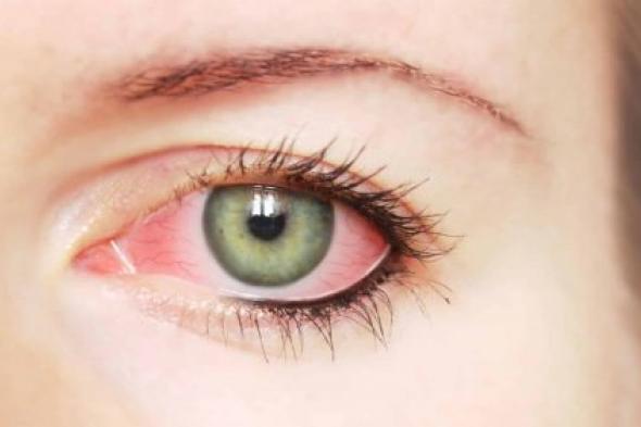 مجموعة أمراض قد تسبب العمى .. تعرّف على الجلوكوما