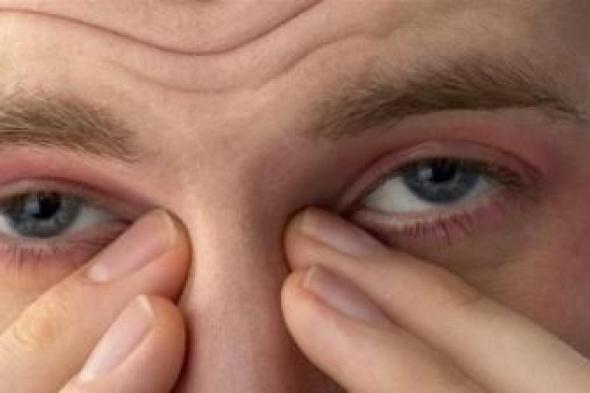 ما هو الصداع النصفي العيني؟