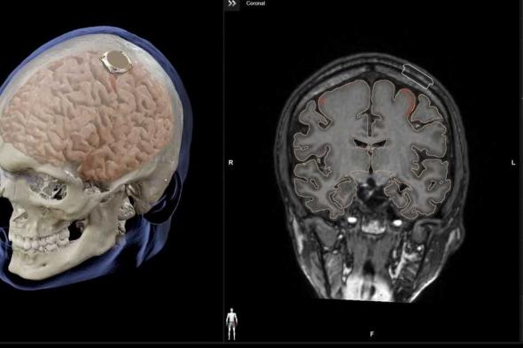 العالم اليوم - إيلون ماسك يعلن عن نجاح زرع شريحة دماغية في أول إنسان