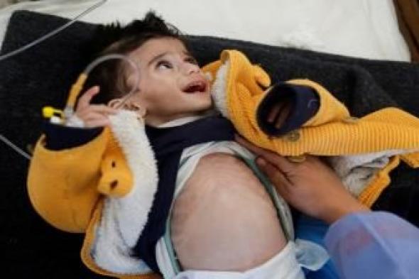 أخبار اليمن : ارتفاع شهداء سوء التغذية والجفاف بغزة إلى 23